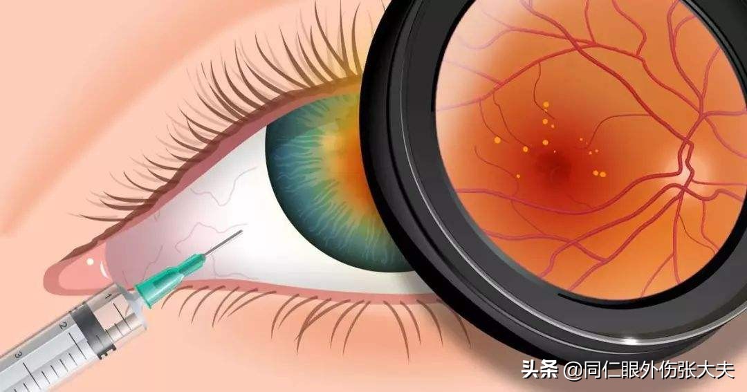 眼球旁边有黄斑怎么回事，什么是抗VEGF药物治疗