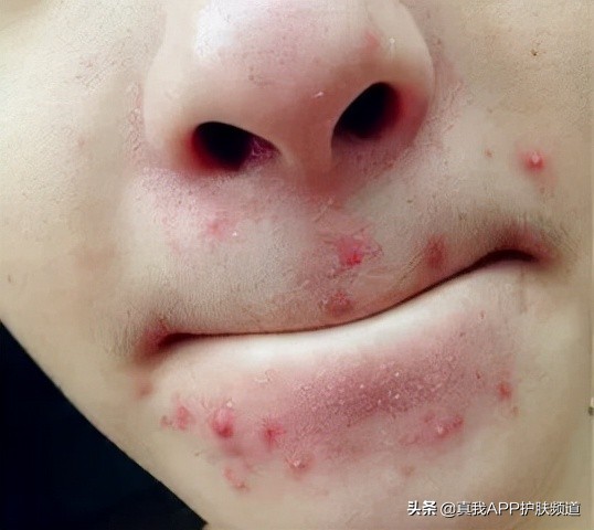 下巴和脖子交界处总长痘痘是什么原因，该怎么办？